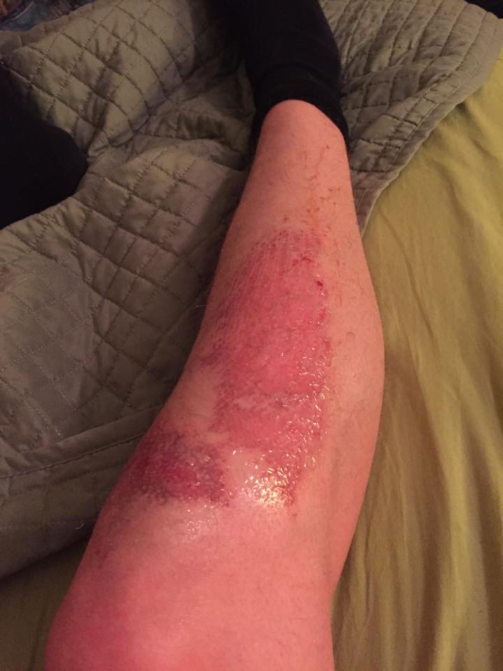 "The struggle of playing soccer on turf. Some lost skin and pain for days." -Steven Wagner